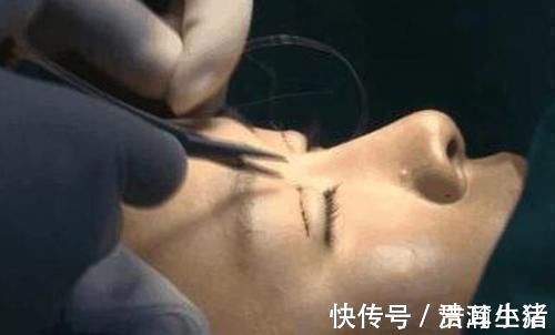 眼角膜|女子花60000整容,术后却整成“凹陷鼻”,找其理论主刀医生闭门不见