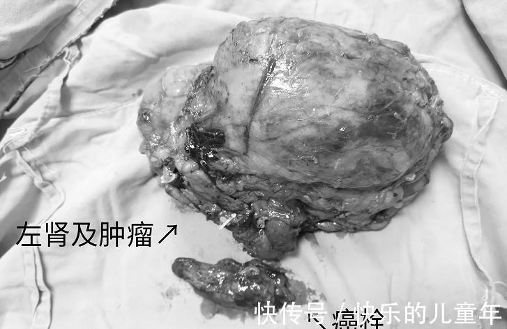 湖南省人民医院|腰痛一年多，男子肾脏长“鹅蛋”肿瘤！专家勇闯“雷区”成功摘除