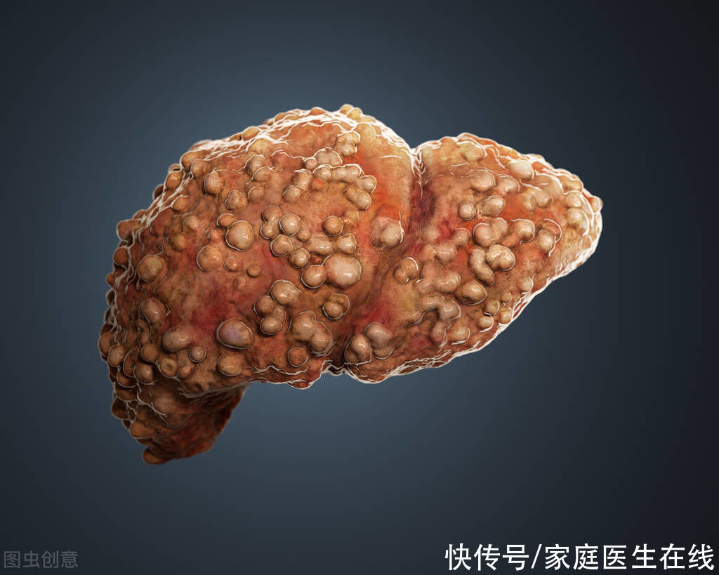  肝硬化|肝硬化的代偿期和失代偿期有什么不一样？主要有这5大区别