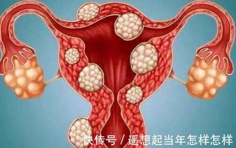 子宫肌瘤|女人为何会患上子宫肌瘤呢?有4个原因,女人们心里要清楚!