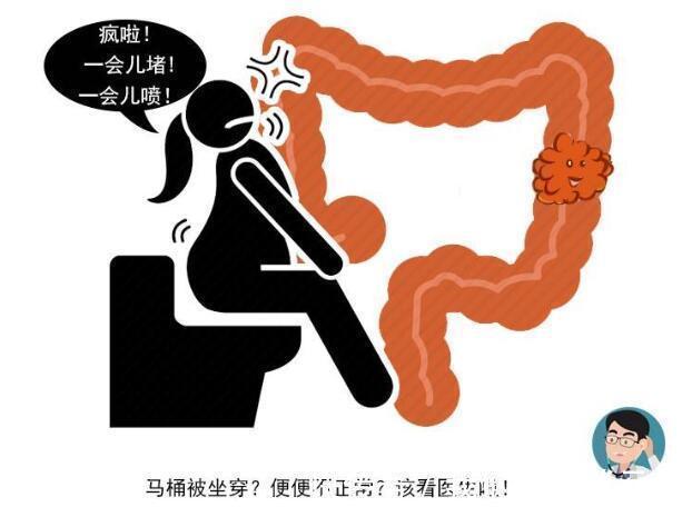 大便|排便莫名出现4种征兆,或暗示大肠癌易上身,趁早检查,别忽视