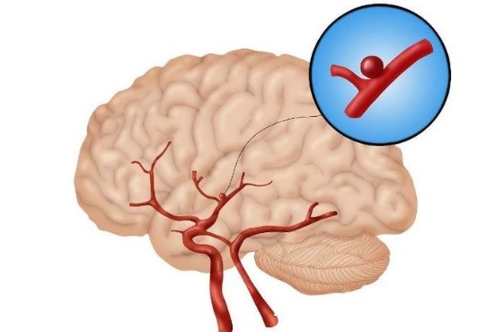 手术治疗|60岁大爷深夜脑出血，医生直言：都这个年纪了，还不懂节制！
