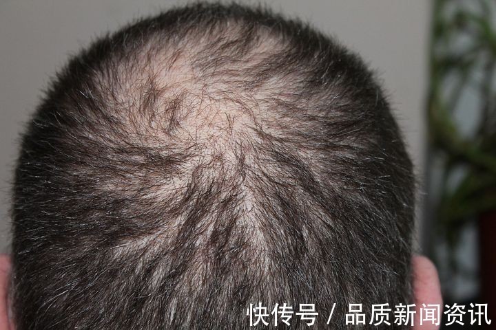 植发 厚森植发-植发,你了解多少?