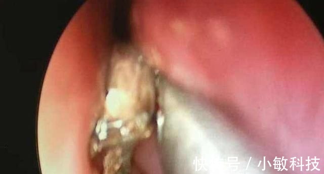 乐乐|6岁男孩不停打喷嚏,妈妈用手电筒一照,身上的汗毛都竖起来了