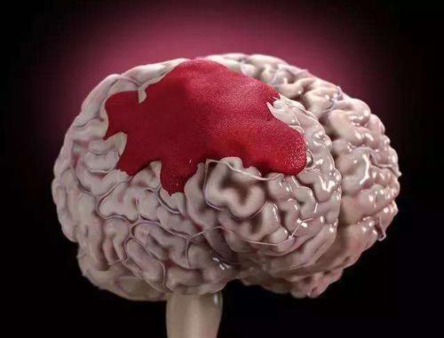 持续性|做好这5件事可稳定血压，警惕高血压对脑组织的3大损害