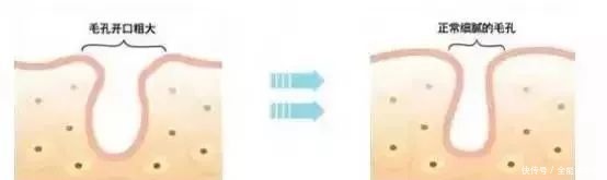 粗大|毛孔粗大问题多?教你5招快速收缩毛孔