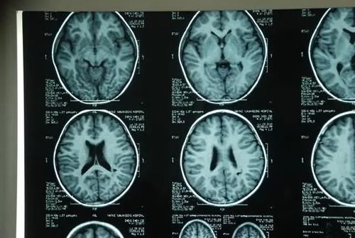 患者|为什么“磁共振”尽量不要做？或许你还不明白，检查这2点需注意