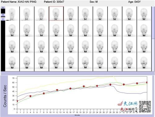 唾液|口干影响生活怎么办？唾液腺显像帮您找答案