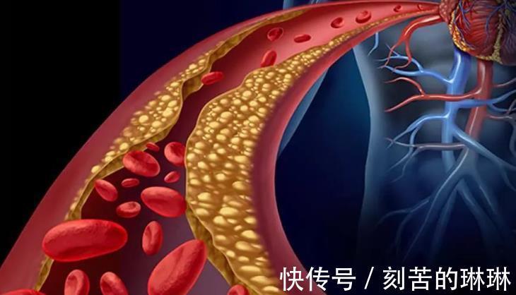 素食|豆制品是高血脂“发物”提醒缓解血脂升高,3种素食建议少吃