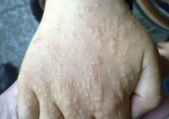 苔藓样疹|好发于儿童手背的皮炎：摩擦性苔藓样疹
