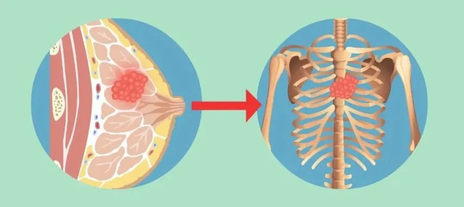 乳腺癌|宁信偏方不信医生，58岁舟山大姐乳腺癌发生骨转移！这些“坑”本可避免