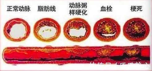 斑块|老年人是不是都会长颈动脉斑块？要紧吗？该咋办？