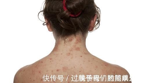 中药|一味中药,深藏绝技!不论脾有病,胃有病,治湿疹,治腰痛!用它全搞定