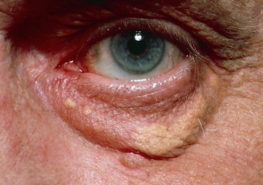 结子|血脂高不高,查看身上3个部位就知道,稳定血脂谨记2少2多