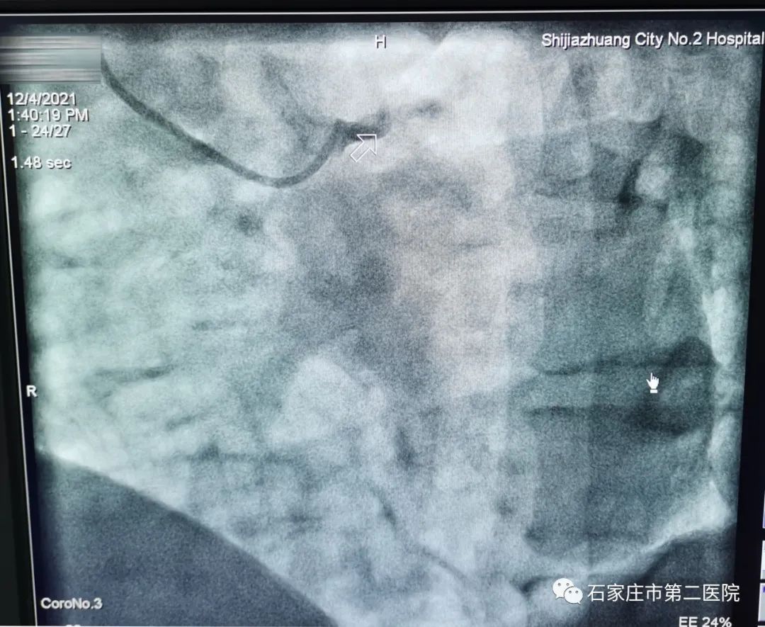 上肢|事发石家庄：36岁男子突发心梗！这12个预兆，关键时刻能救命！