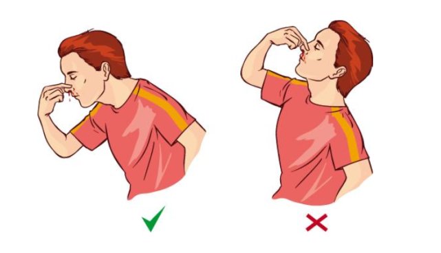 黏膜|流鼻血高发季到了，伴有5类症状请立即就医