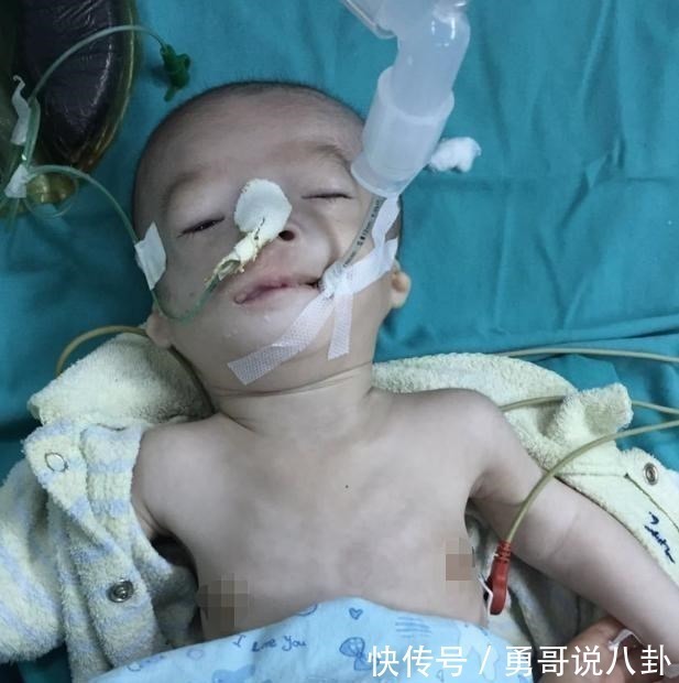 遗传|“鸟脸”妈妈不顾劝阻生二胎,二宝没躲过遗传,是任性还是母爱