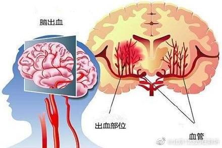 上厕所|为什么脑出血多在上厕所的时候发生？