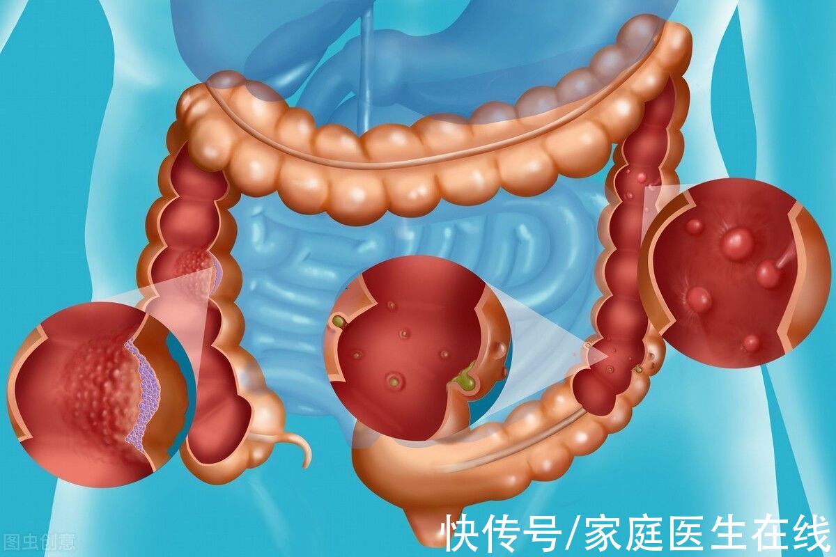 肠息肉|得了肠息肉2年没复查险成肠癌，这几种息肉，还是切了吧！别拖了