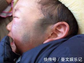 血管瘤|要想宝宝出生后不长胎记,孕期避免这几件事就OK,你做到了几条