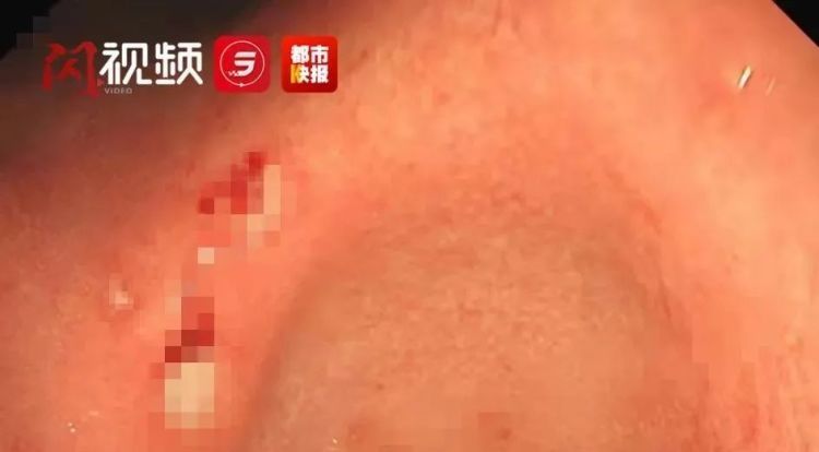 山楂|西安大妈胃里长出鸡蛋大结石 只因为吃了它……