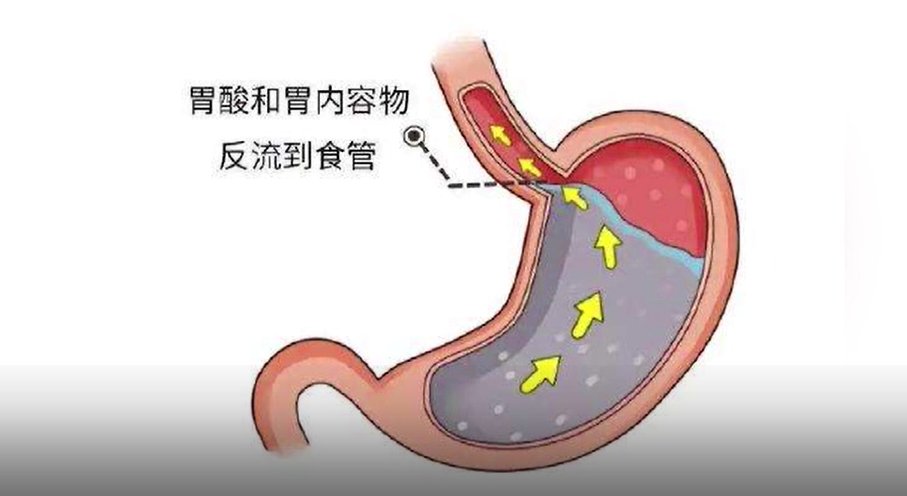 浙江省人民医院|省内首例！女子反酸、烧心 一枚“戒指”解除痛苦