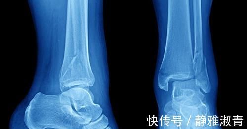 心脏早搏|很多“病”不算病，只是因为年纪大了：这4种疾病，不用过度治疗