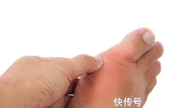 飙升|高尿酸人群注意:桌上3种美食,一口都不能多吃,尿酸飙升很快