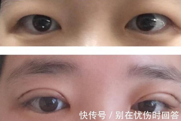 瘢痕 双眼皮术后出现肉条的不同原因和修复方法
