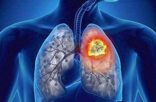 上涨|近年肺结节患者呈上涨趋势，多吃1黄1白，或许有助于消除肺结节