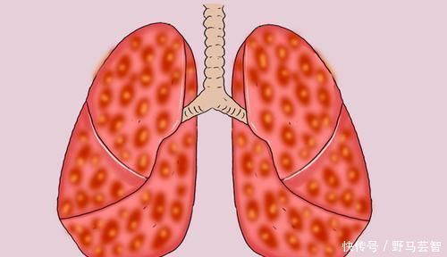 肺癌转移率有多大呼吸科医生3个部位易被攻击,留意异常表现