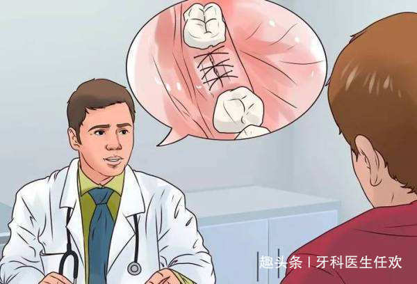 牙龈|拔牙后缝合伤口的线需要拆除吗