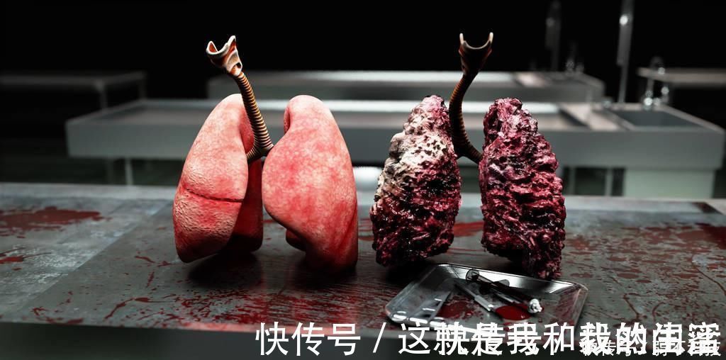 肺癌|吸烟者,身体一旦出现“1大2痛”,八成是肺癌上身,具体指什么