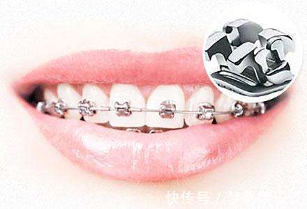矫正|儿童做牙齿矫正三个最佳时间:家长要牢记,矫治越早干预效果越好