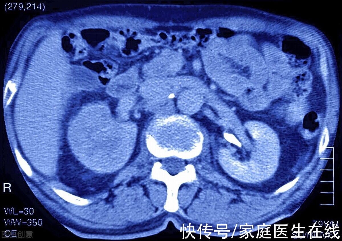治疗|肾癌的发病率越来越高？了解这6个小常识，早点预防肾癌