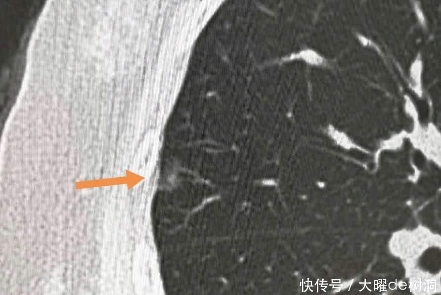 年年体检,为什么还得了晚期肺癌?体检有啥用!