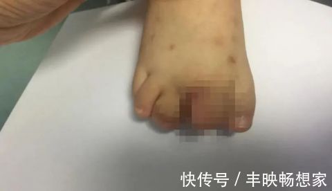 宝宝|得了这病,半岁宝宝脚趾比香蕉还粗!不注意还会复发…