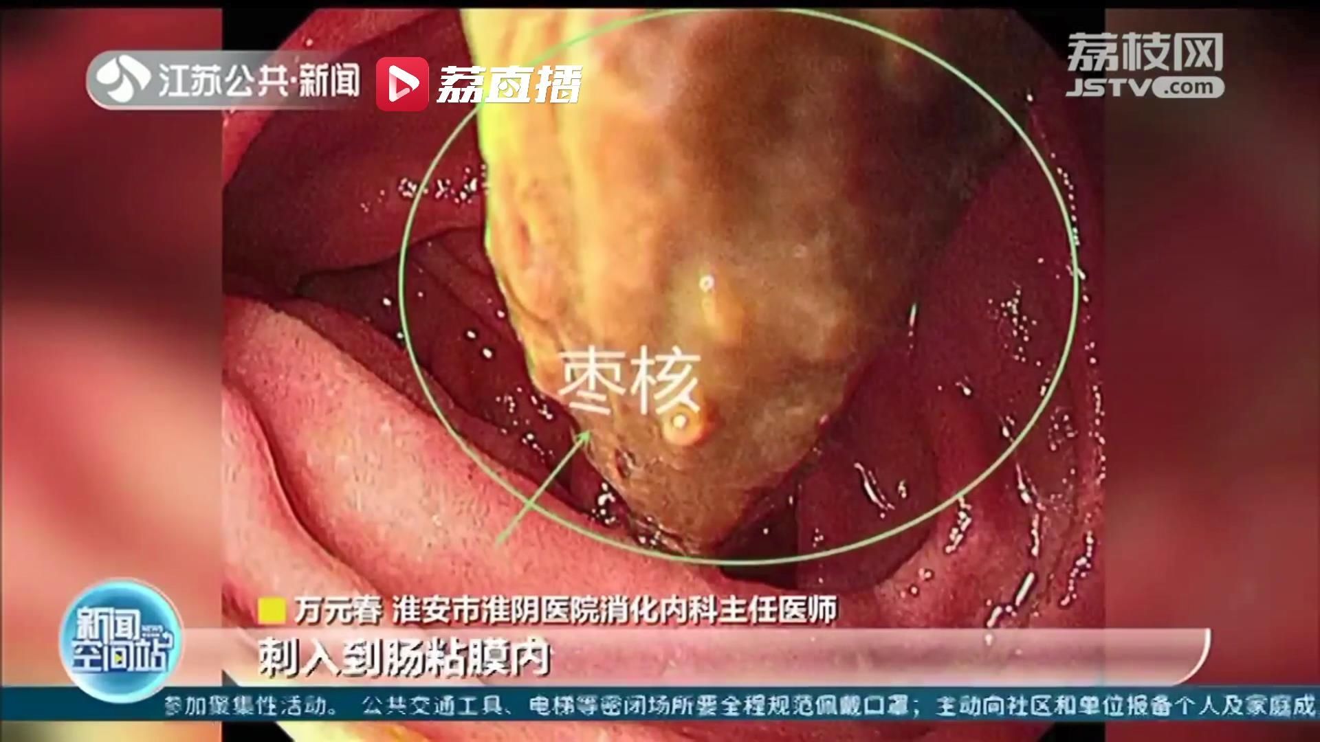 十二指肠|淮安一六旬老人“囫囵吞枣”后腹痛难忍 医生妙手取出枣核