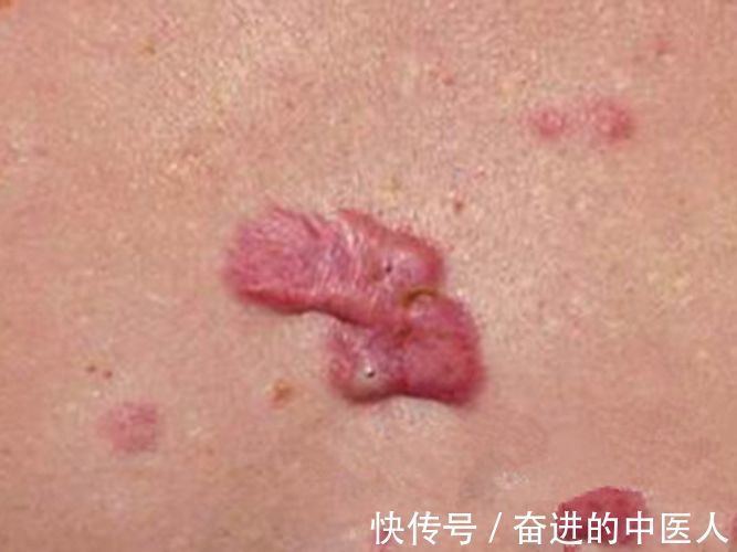 华西|成都中医肿瘤研究院(万年路2号):特邀华西退休团队会诊中医治皮肤瘤