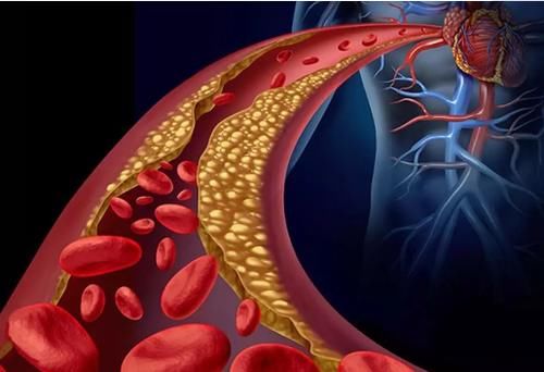 中老年人|60岁大叔无故晕倒，查出是高血脂。后“日行万步”，现在怎么样了