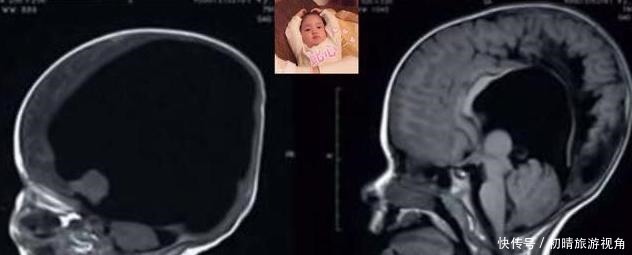 胎儿|产妇生下无脑宝宝,夫妻不离不弃照顾3年,现状如何
