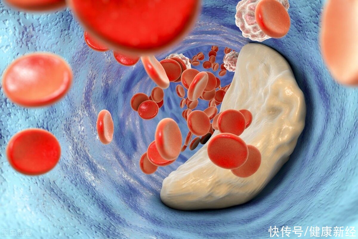 保护血管|身体若出现这3种情况，可能是“脑梗”的信号，早知道早预防