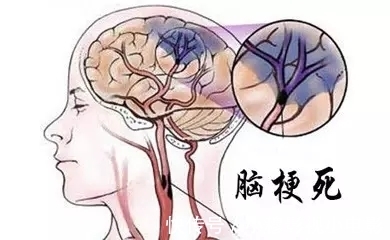 美国心脏协会|脑梗死越来越多，哈佛大学医学院：坚持做到这7件事，远离脑梗