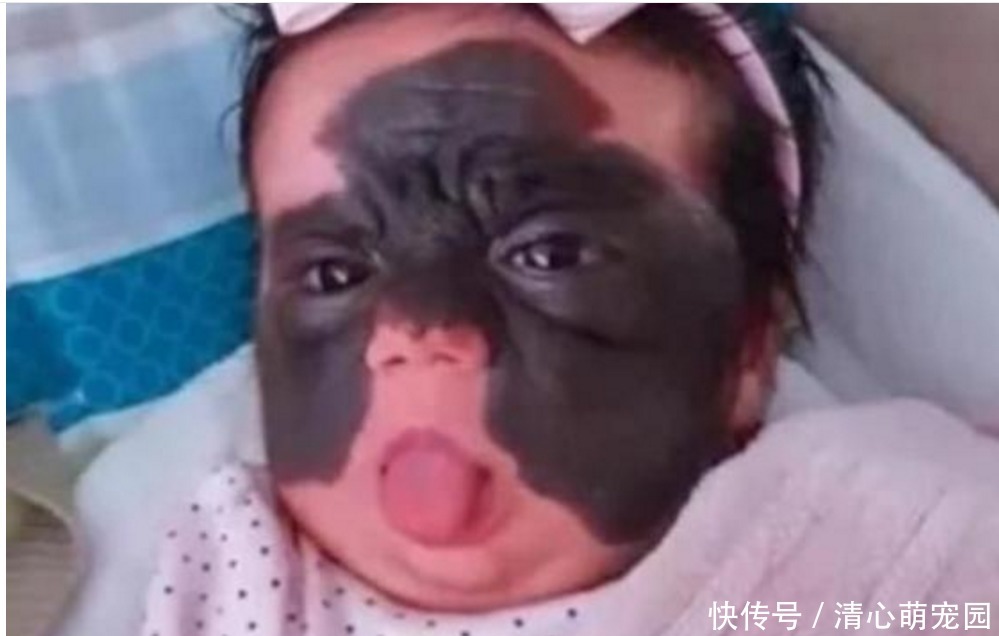 女婴一出生伴随“蝙蝠侠印记”,被父母送去整容7次,结果怎样了