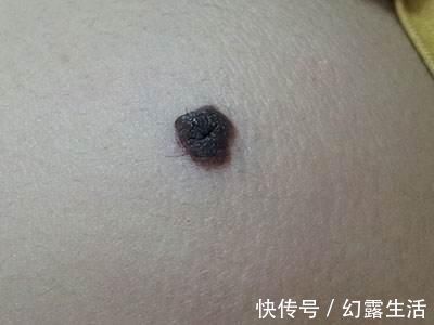 皮肤|皮肤上的痣发生这些变化, 还请尽快去医院找医生就诊!
