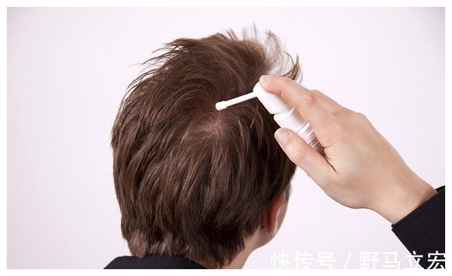 脱发|中年油腻男的标准出炉了,男性不妨自测下,希望你一个也不占