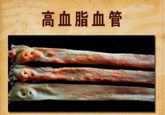 血管|高血脂“克星”公开，避免做这几件事，血管干净通畅