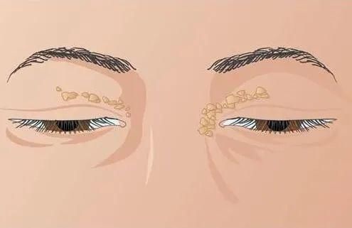 血管堵塞|甘油三酯“溶解剂”大公开！不是洋葱，坚持吃或能降低血脂