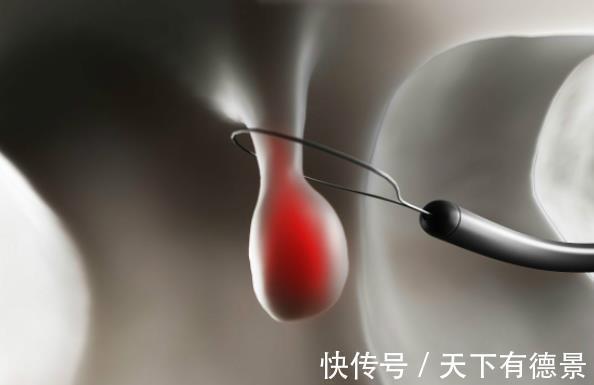 肿块|三个良性肿块必须及时切除,延迟就会变成恶性肿瘤!你清楚吗?