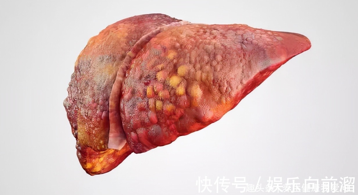 乙型肝炎|34岁确诊晚期肝硬化,从绝望到重生,我靠这一疗法战胜了它